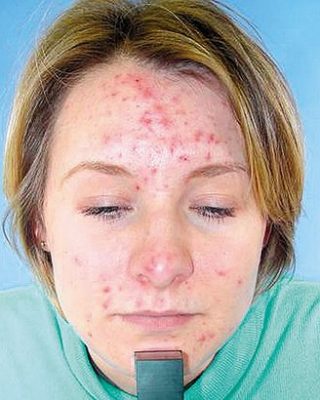 acne-ozonoterapia