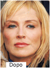 sharon-stone-dopo-ozonoterapia